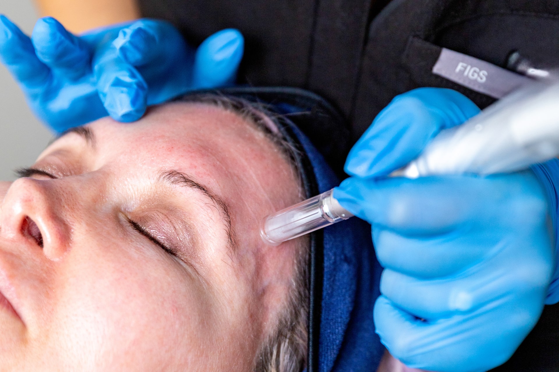 Microneedling, a form of collagen for face treatment, being performed on a patient’s forehead 